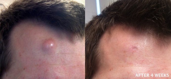 before and after cyst removal