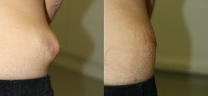 before and after cyst treatment