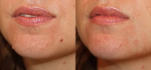 chin mole removal