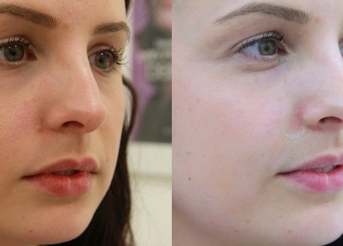 mole removal blog before and after
