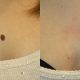 mole removal chest