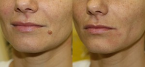 mole removal chin