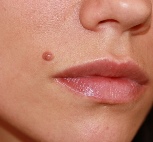 mole removal lips