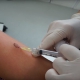 mole removal local anaesthetic