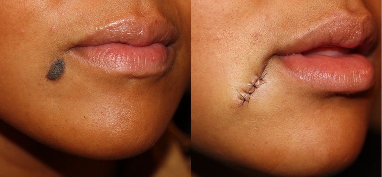 Removal Stitches Mole