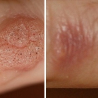 wart removal before and after