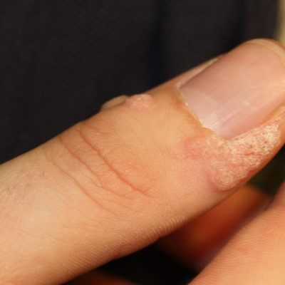 finger warts
